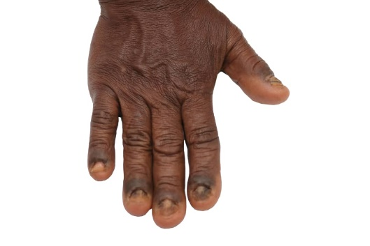 Figure 3a - Fingernails after 16 months of HGFP Figure 3